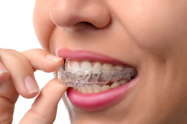 How much do braces cost for Invisalign?
