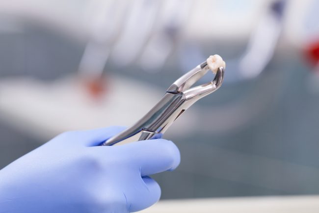 actual extraction of wisdom teeth cost